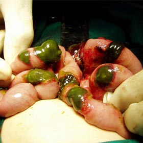 Intestinal Obstruction