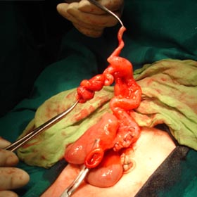 Intestinal Obstruction