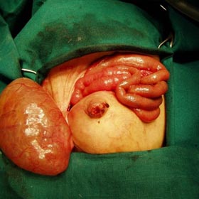 Intestinal Obstruction